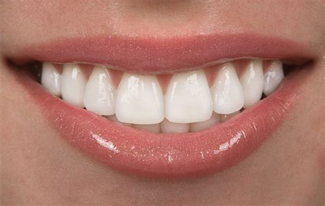 Composite Veneers: What You Should Know.